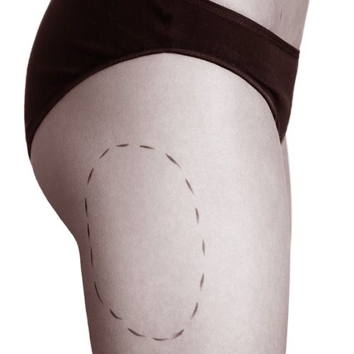 cruroplastia - cirugia murcia