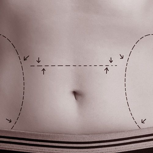 liposuccion - murcia